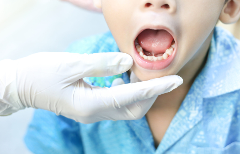 Doctor,Screening,And,Diagnosis,Mouth,Of,Tongue-tie,Patient,,,Dental