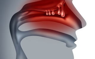 Nasal Polyps