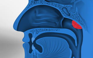 adenoiditis_1280