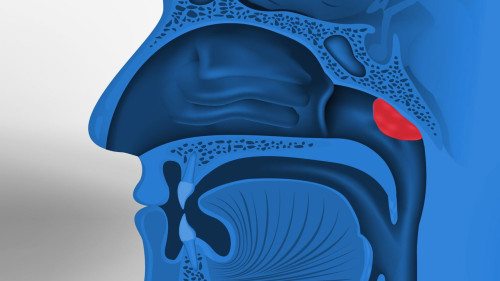 adenoiditis_1280