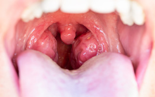 The child is a patient with large red glands. Tonsils in close-up in the mouth. Closeup view of open mouth with tonsils