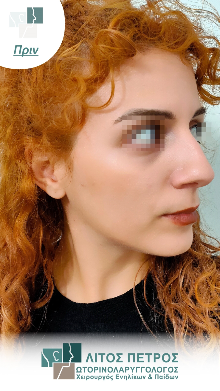 ΩΡΛ-Λίτος Πέτρος - ΩΤΟΡΙΝΟΛΑΡΥΓΓΟΛΟΓΟΣ-ΩΡΛ ΕΝΗΛΙΚΩΝ-ΩΡΛ ΠΑΙΔΩΝ-ΡΙΝΟΠΛΑΣΤΙΚΗ-rinoplastiki-prin-case-29